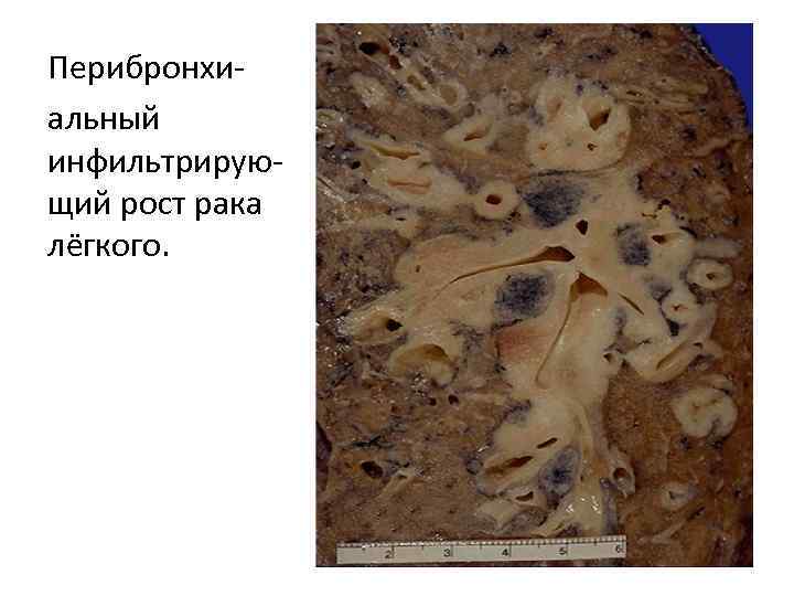 Перибронхиальный инфильтрирующий рост рака лёгкого. 