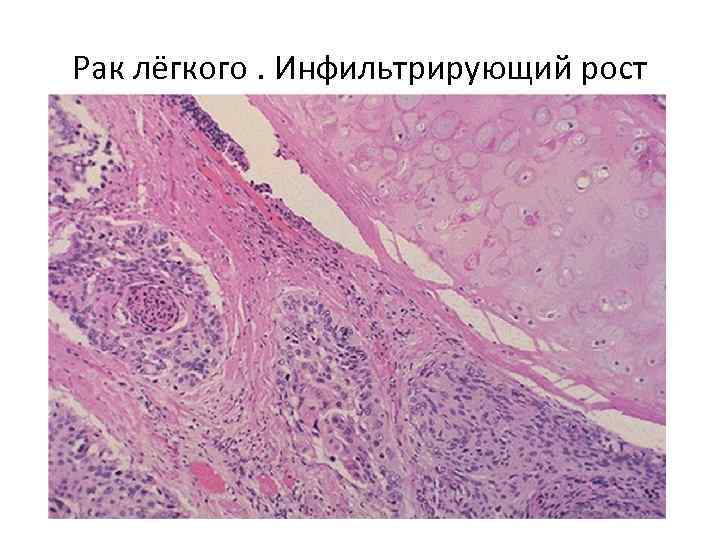 Рак лёгкого. Инфильтрирующий рост 