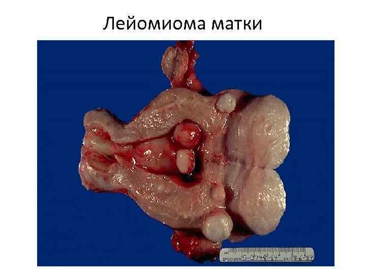 Лейомиома матки 