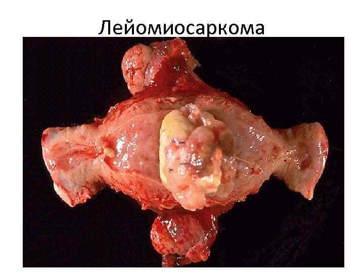 Лейомиосаркома 