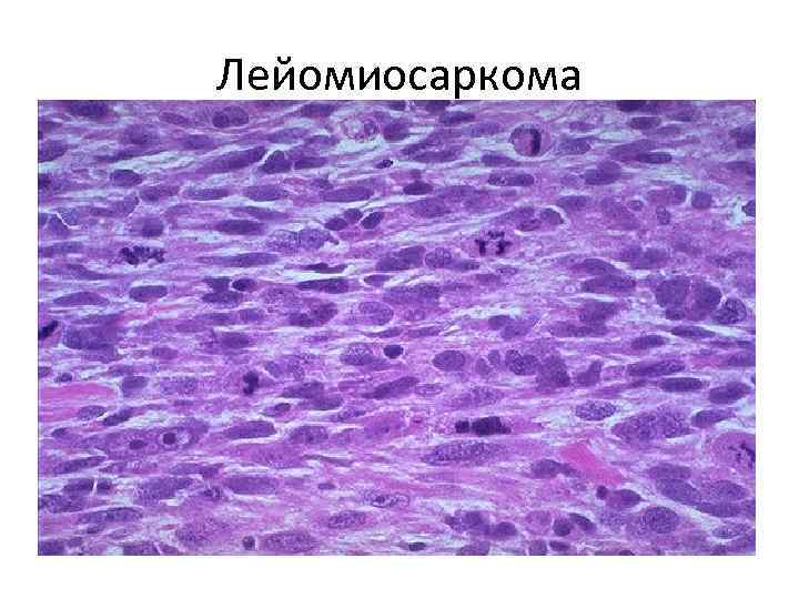 Лейомиосаркома 