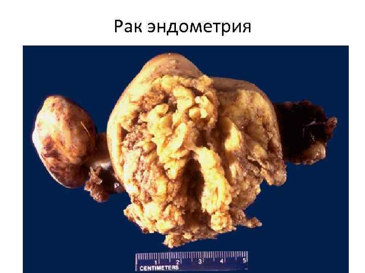 Рак эндометрия 