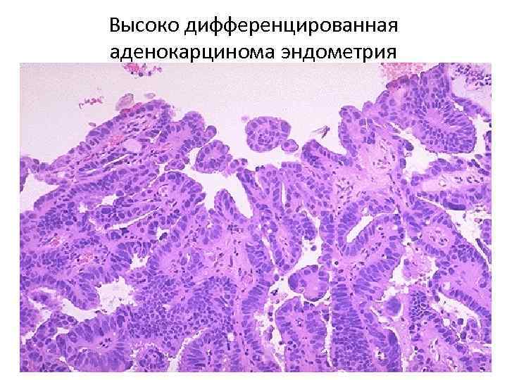 Высоко дифференцированная аденокарцинома эндометрия 