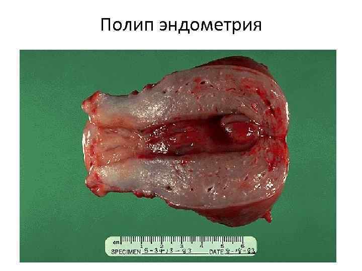 Полип эндометрия 