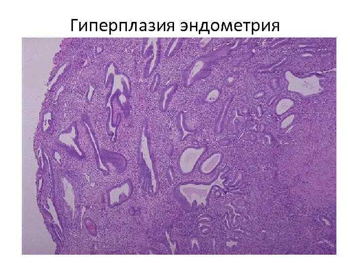 Гиперплазия эндометрия 