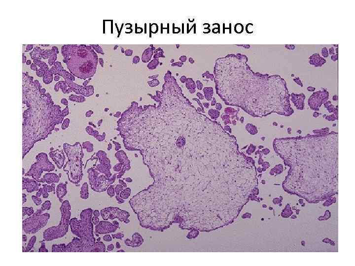 Пузырный занос 