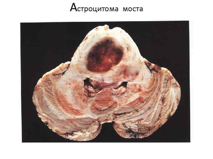 Астроцитома моста 