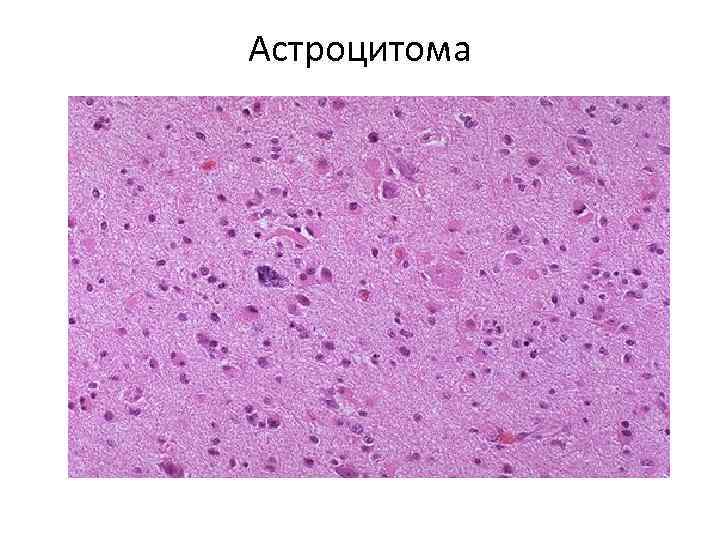 Астроцитома 