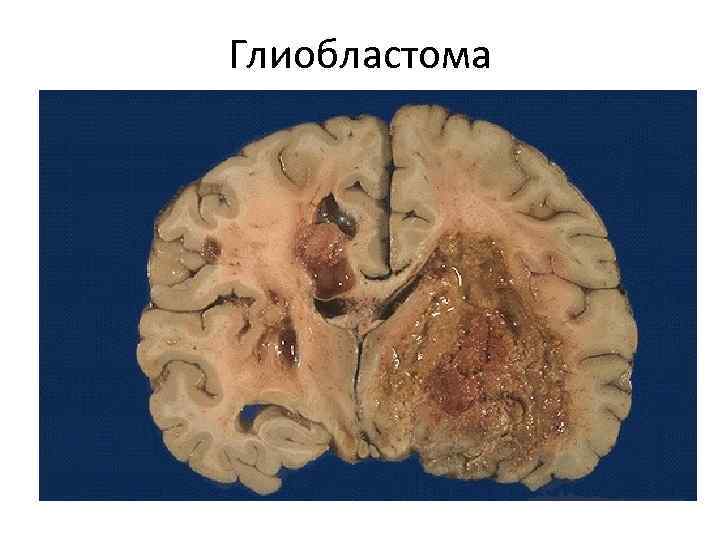 Глиобластома 