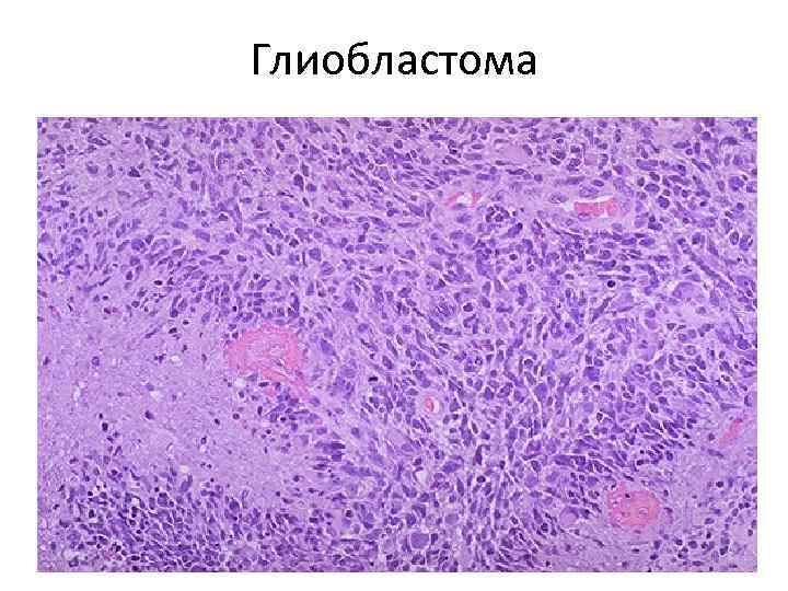Глиобластома 