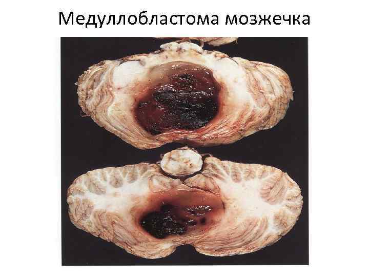 Медуллобластома мозжечка 