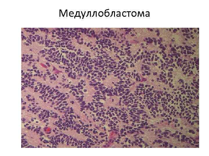 Медуллобластома 