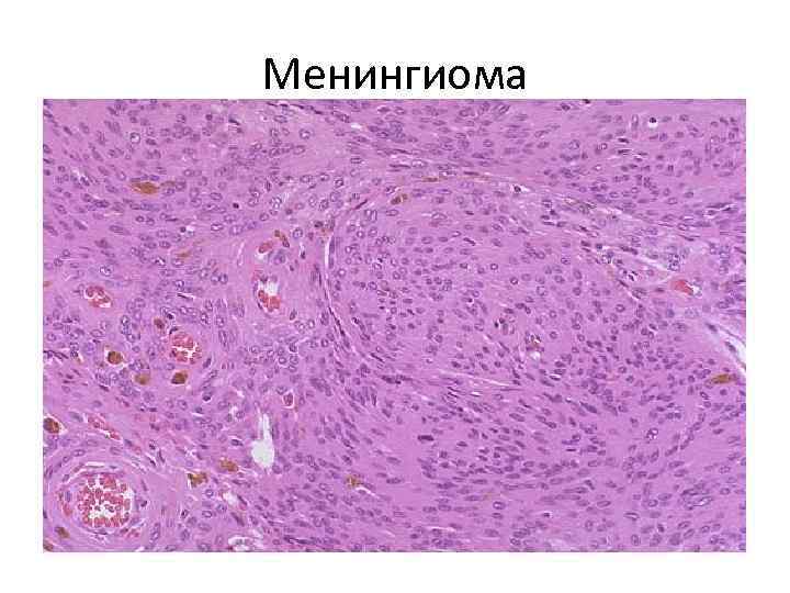Менингиома 