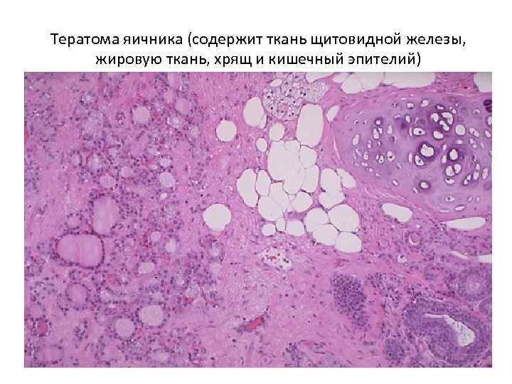 Тератома яичника (содержит ткань щитовидной железы, жировую ткань, хрящ и кишечный эпителий) 
