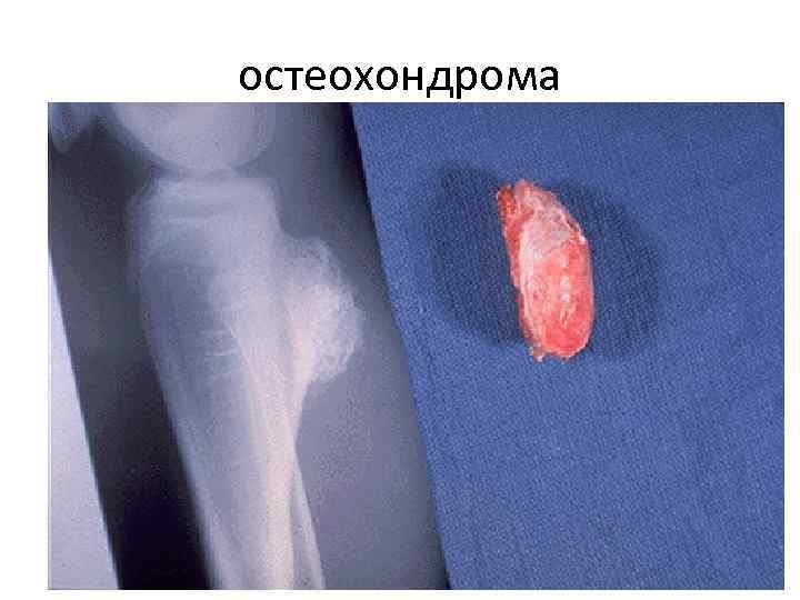 остеохондрома 