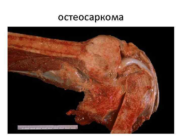 остеосаркома 