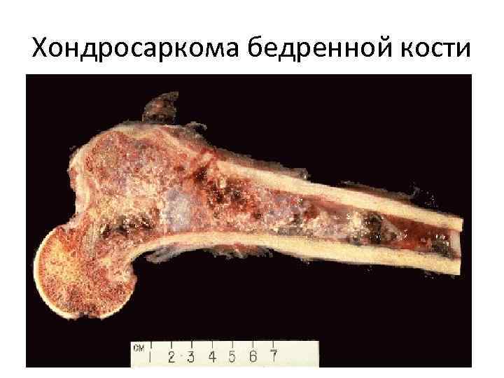 Хондросаркома бедренной кости 