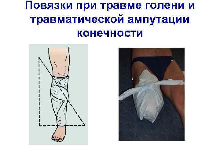 Повязки при травме голени и травматической ампутации конечности 