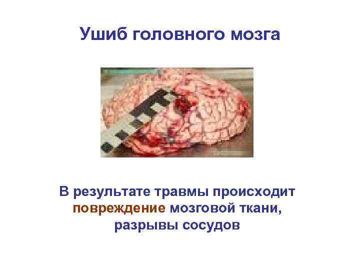 Ушиб головного мозга В результате травмы происходит повреждение мозговой ткани, разрывы сосудов 