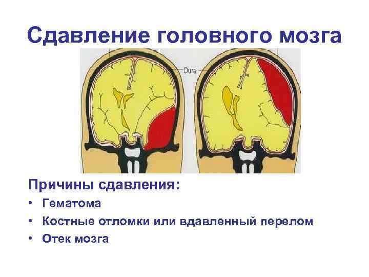 Сдавление головного мозга Причины сдавления: • Гематома • Костные отломки или вдавленный перелом •
