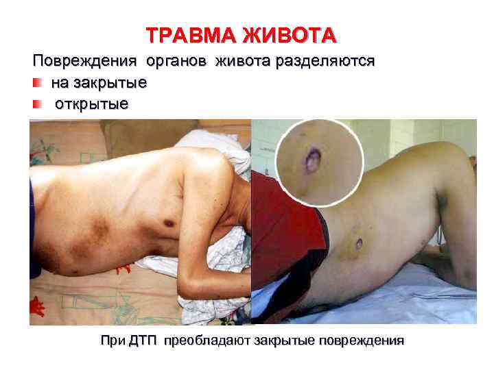 ТРАВМА ЖИВОТА Повреждения органов живота разделяются на закрытые открытые При ДТП преобладают закрытые повреждения