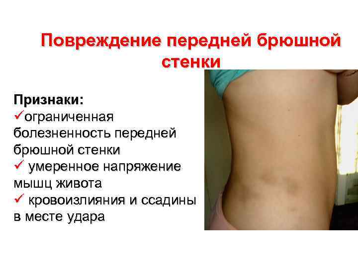 Повреждение передней брюшной стенки Признаки: üограниченная болезненность передней брюшной стенки ü умеренное напряжение мышц