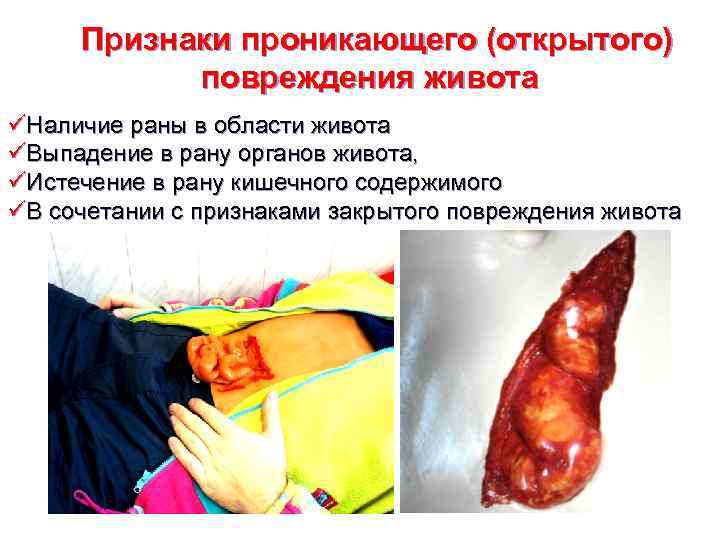 Признаки проникающего (открытого) повреждения живота üНаличие раны в области живота üВыпадение в рану органов