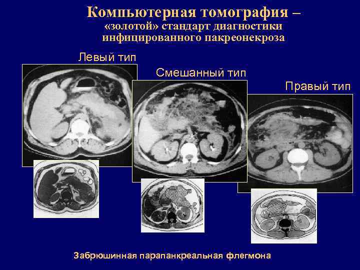 Компьютерная томография – «золотой» стандарт диагностики инфицированного пакреонекроза Левый тип Смешанный тип Правый тип