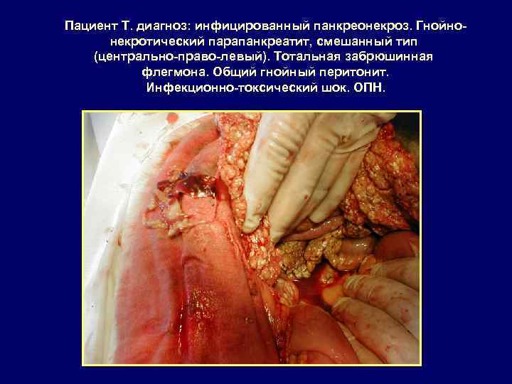 Пациент Т. диагноз: инфицированный панкреонекроз. Гнойнонекротический парапанкреатит, смешанный тип (центрально-право-левый). Тотальная забрюшинная флегмона. Общий