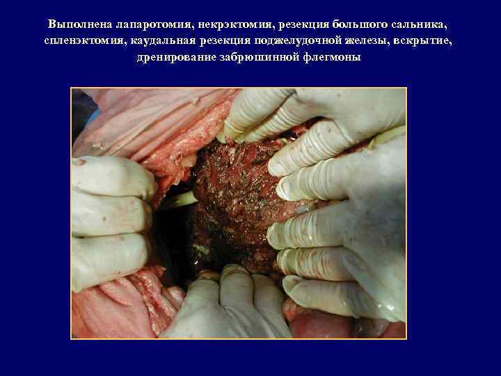 Выполнена лапаротомия, некрэктомия, резекция большого сальника, спленэктомия, каудальная резекция поджелудочной железы, вскрытие, дренирование забрюшинной