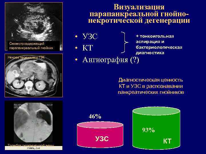 Визуализация парапанкреальной гнойнонекротической дегенерации Секвестрсодержащий парапанкреальный гнойник Некроз паренхимы ПЖ + тонкоигольная • УЗС