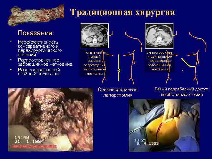 Традиционная хирургия Показания: • • • Неэффективность консервативного и парахирургического лечения Распространенное забрюшинное нагноение