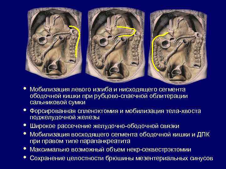  • • • Мобилизация левого изгиба и нисходящего сегмента ободочной кишки при рубцово-спаечной