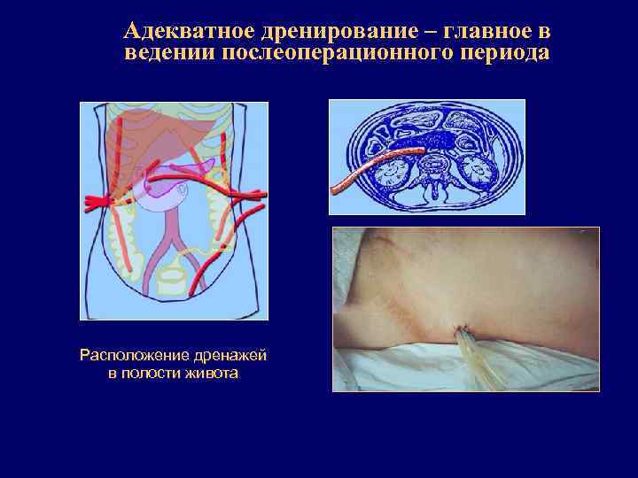 Адекватное дренирование – главное в ведении послеоперационного периода Расположение дренажей в полости живота 