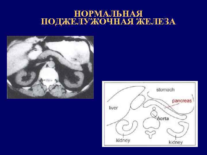 НОРМАЛЬНАЯ ПОДЖЕЛУЖОЧНАЯ ЖЕЛЕЗА 