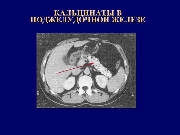 КАЛЬЦИНАТЫ В ПОДЖЕЛУДОЧНОЙ ЖЕЛЕЗЕ 
