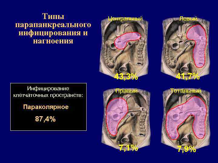 Типы парапанкреального инфицирования и нагноения Левый 43, 3% Инфицирование клетчаточных пространств: Центральный 41, 7%