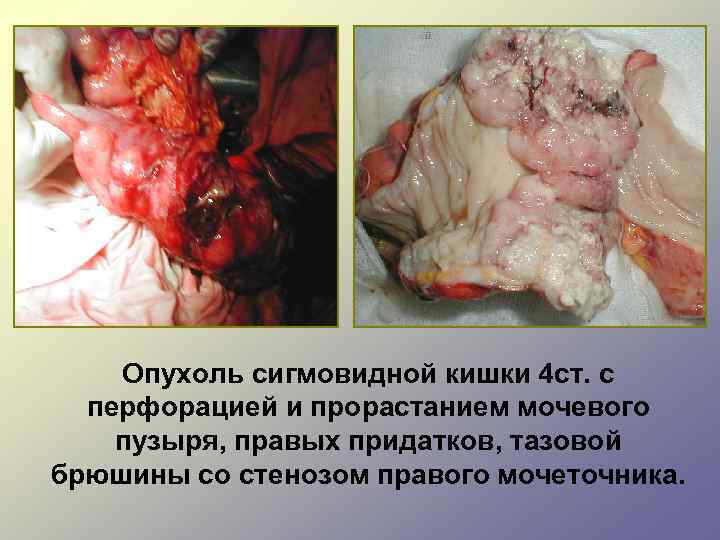 Опухоль сигмовидной кишки 4 ст. с перфорацией и прорастанием мочевого пузыря, правых придатков, тазовой