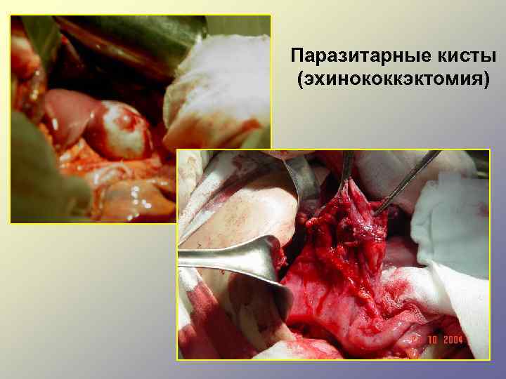 Паразитарные кисты (эхинококкэктомия) 
