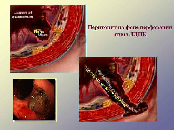Перитонит на фоне перфорации язвы ЛДПК Язва Пе рф ор ац ио нн ое