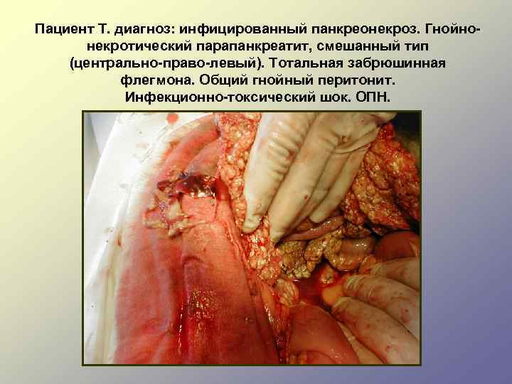 Пациент Т. диагноз: инфицированный панкреонекроз. Гнойнонекротический парапанкреатит, смешанный тип (центрально-право-левый). Тотальная забрюшинная флегмона. Общий
