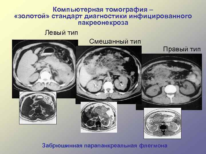 Акушерский перитонит картинки