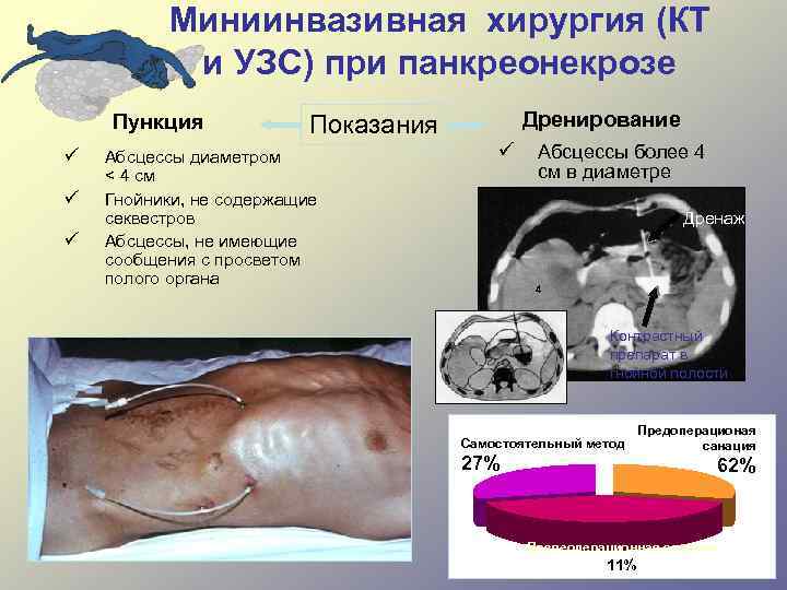 Миниинвазивная хирургия (КТ и УЗС) при панкреонекрозе Пункция ü ü ü Показания Абсцессы диаметром