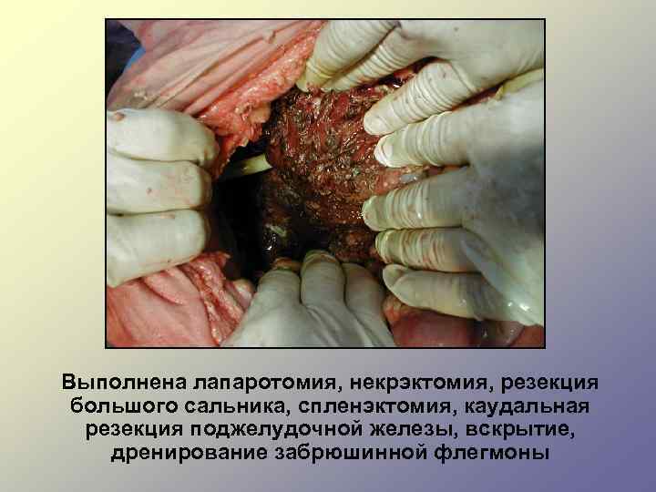 Выполнена лапаротомия, некрэктомия, резекция большого сальника, спленэктомия, каудальная резекция поджелудочной железы, вскрытие, дренирование забрюшинной