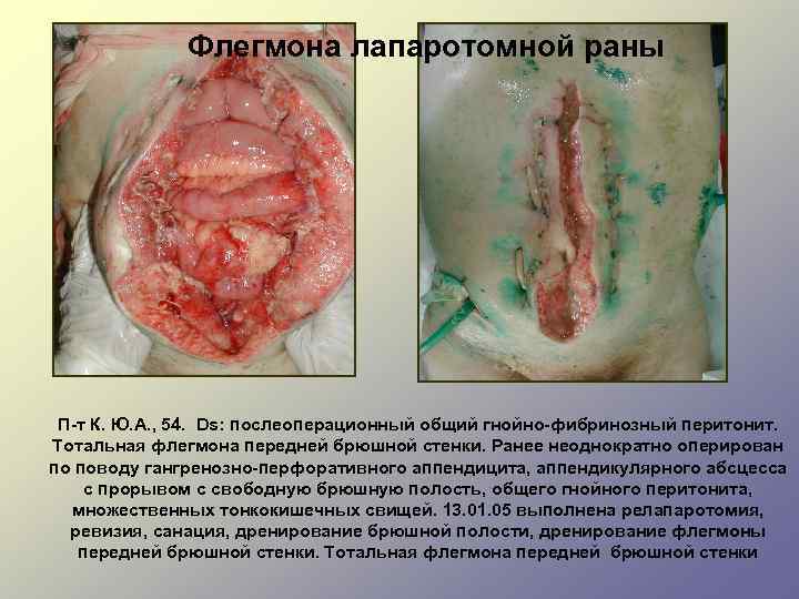 Флегмона лапаротомной раны П-т К. Ю. А. , 54. Ds: послеоперационный общий гнойно-фибринозный перитонит.