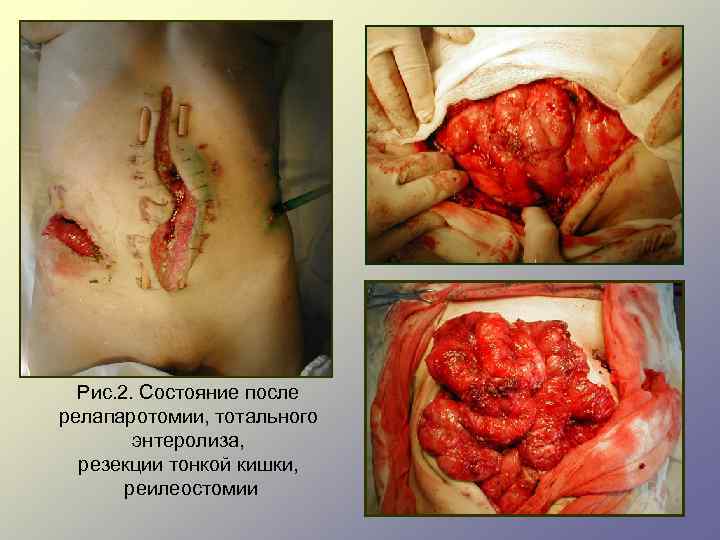 Рис. 2. Состояние после релапаротомии, тотального энтеролиза, резекции тонкой кишки, реилеостомии 
