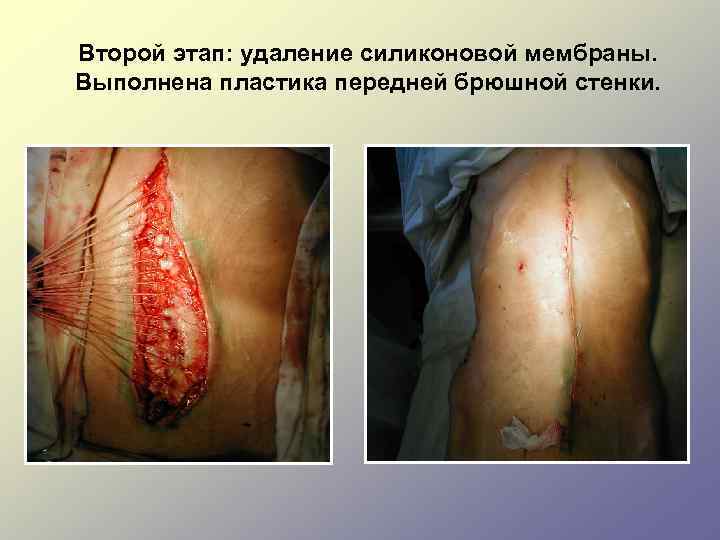 Второй этап: удаление силиконовой мембраны. Выполнена пластика передней брюшной стенки. 