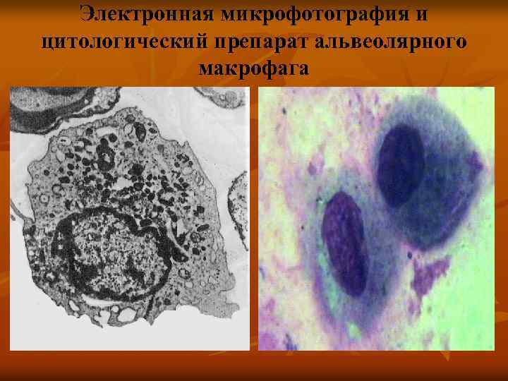 Электронная микрофотография и цитологический препарат альвеолярного макрофага 