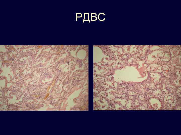 Патологическая анатомия лекции. Шоковое легкое патанатомия. РДВС патологическая анатомия. Местная гиперпигментация кожи проявляется патанатомия. РДВС этиология.