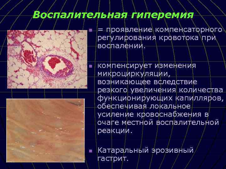 Воспалительная гиперемия n n n = проявление компенсаторного регулирования кровотока при воспалении. компенсирует изменения